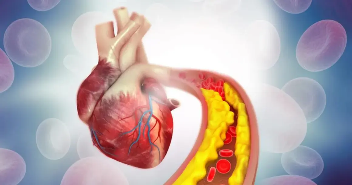 Serce z zatkanym naczyniem krwionośnym, gdzie cholesterol nie-HDL tworzy żółte złogi, utrudniając przepływ czerwonych krwinek.
